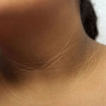 acanthosis nigricans