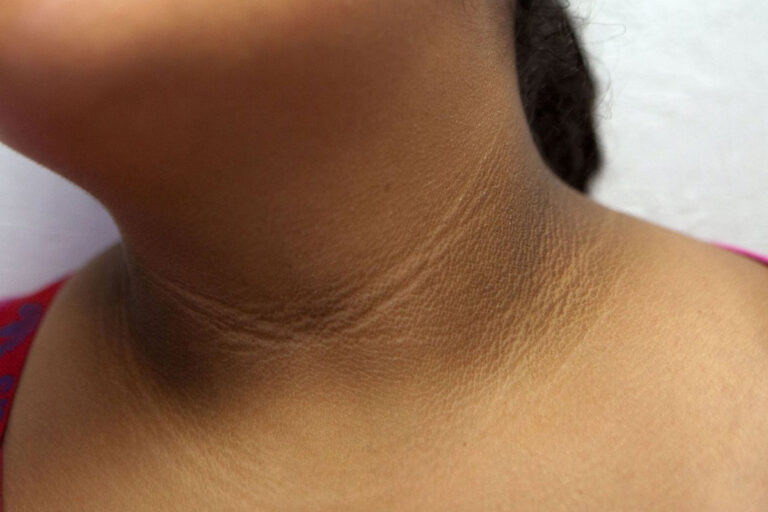 acanthosis nigricans